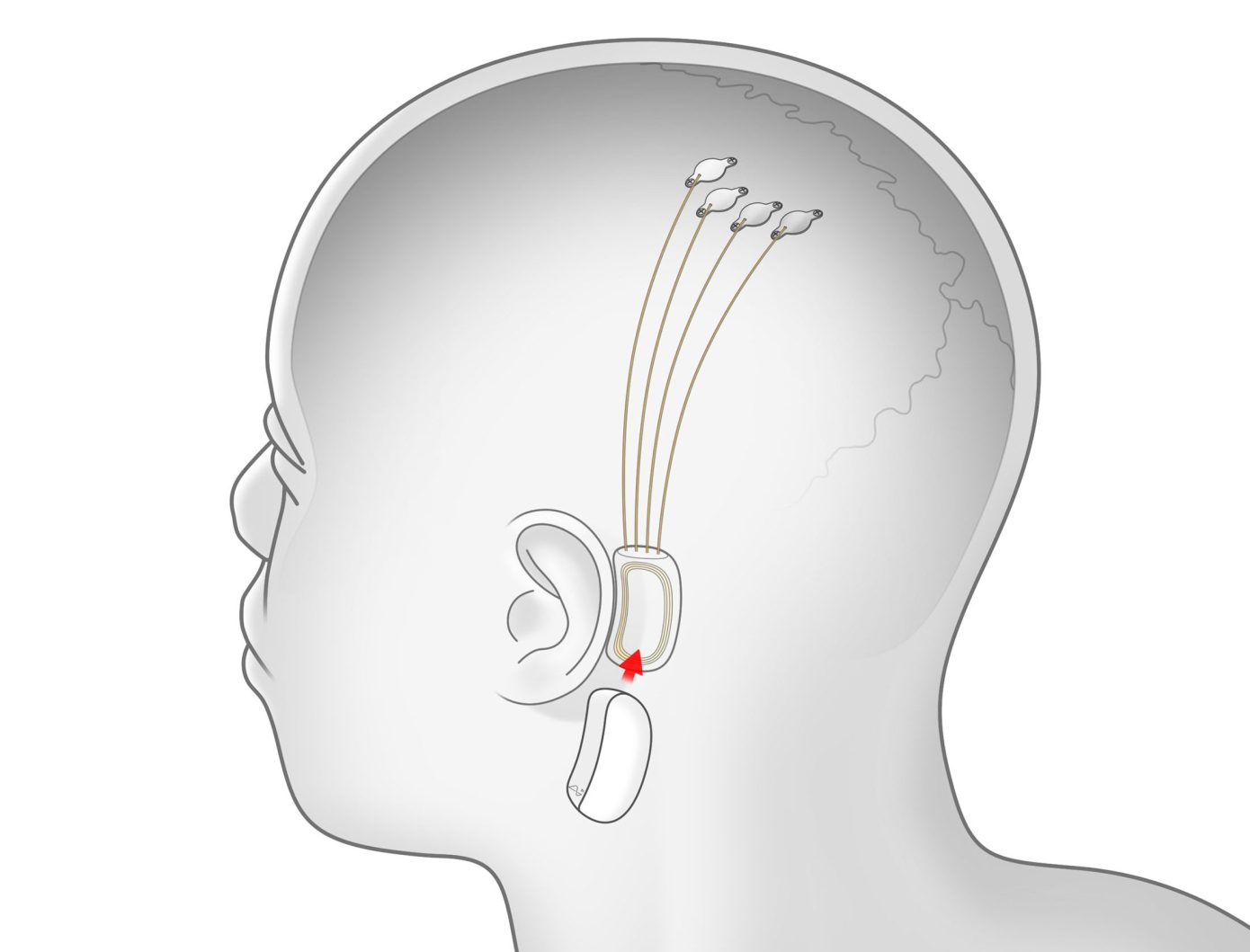 neuralink-implante cerebral